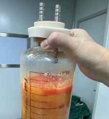 广州水动力吸脂手术要做多久？